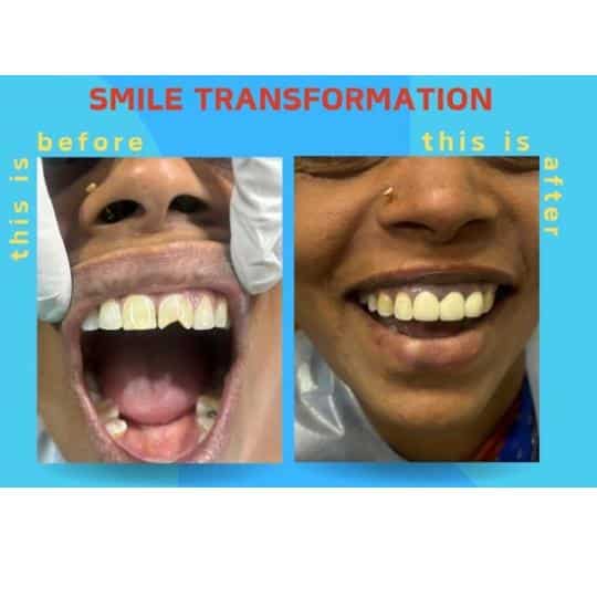 Smile transformation